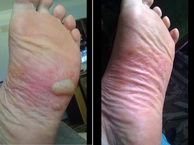 Before and After Foot